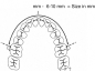 Preview: Arc de distanțare molară, mărimea 2 (83 mm)