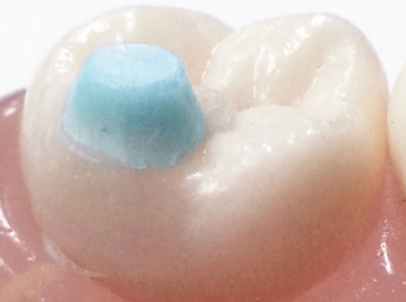 MiniMold System, Pad Tips pentru molari