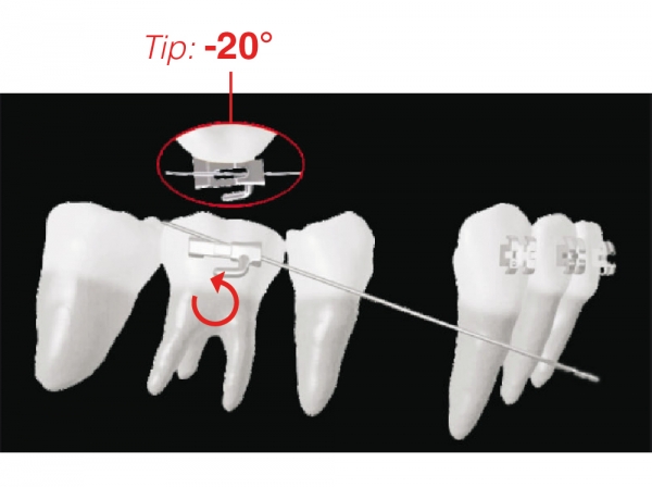 Tubusor bucal colabil XBT pentru indreptarea sau mentinerea primului molar (Dinte 46, 36)
