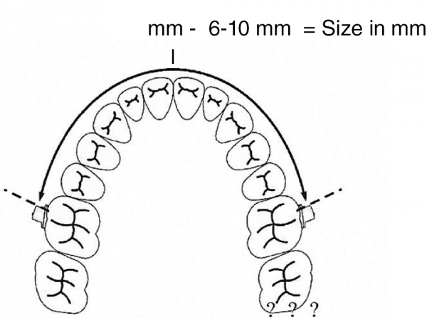 Arc de distanțare molară, mărimea 2 (83 mm)