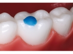 Reliamold™, Pad Tips pentru molari